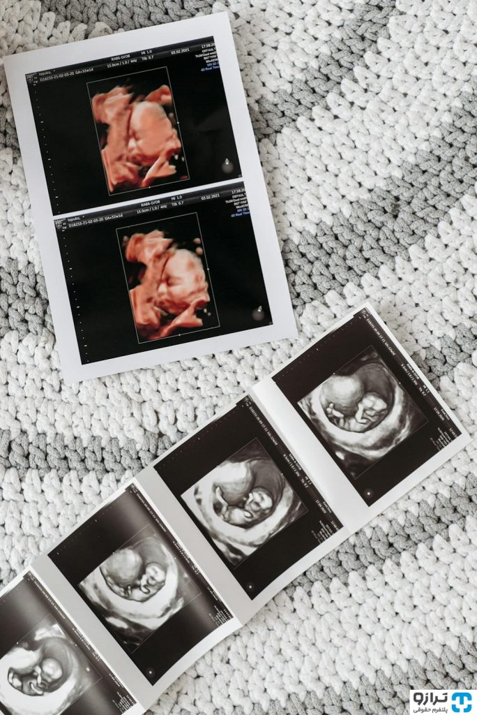 اهدای جنین چیست و چه حکمی دارد؟ 2 EmbryoDonation etarazoo